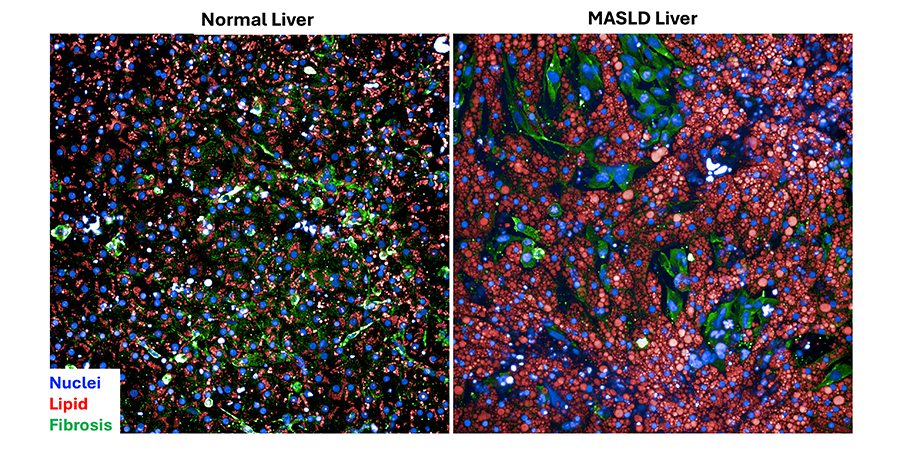 Here, on the left, a normal liver is shown with four different types of cells. On the right, a diseased liver reveals a high amount of fatty lipids and the beginning of fibrosis, a life-threatening type of liver damage. (Dillon Gavlock, University of Pittsburgh Drug Discovery Institute)