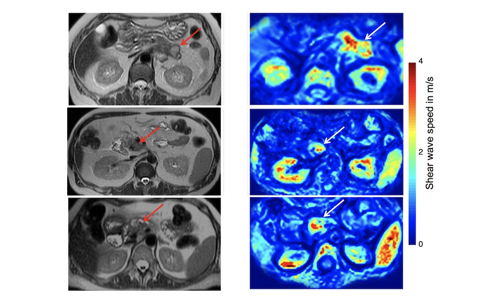 These images from magnetic resonance imaging and magnetic resonance elastography are from a patient with pancreatic cancer. Arrows point to tumors. (Images courtesy of the Doyley lab)